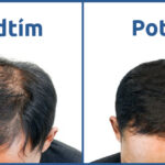 Türkiye’ye Saç Ekimine Gelen Çekler